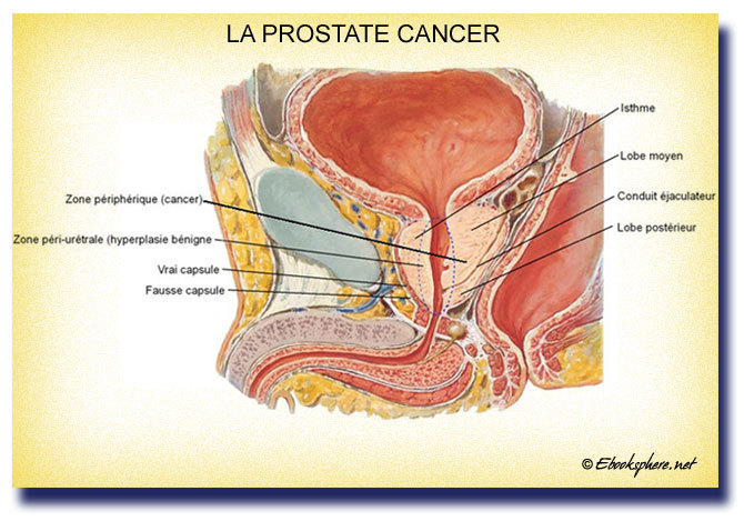 MALADIE: Le cancer de la prostate, ‘’premier cancer en urologie’’ au Sénégal selon un spécialiste