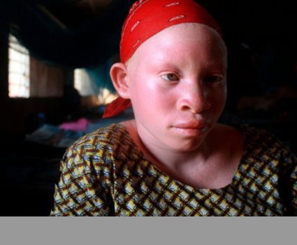 Crainte de pratiques sacrificielles : Les albinos disparaissent de la circulation