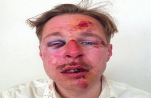Wilfred Buijn, un homosexuel agressé à Paris: « Ils ont utilisé ma tête comme un ballon de foot »