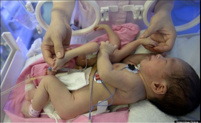 (Photos) Un bébé naît avec quatre jambes et quatre bras. Regardez