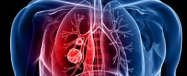 Pourquoi on ne guérit pas du cancer du poumon