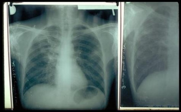 Tuberculose: 12810 cas enregistrés en 2012, soit une augmentation de 1200 cas